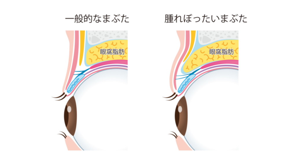 紀尾井町プラザクリニック_二重埋没法01