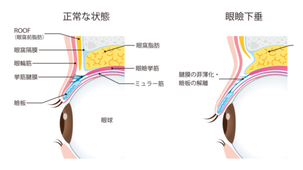 紀尾井町プラザクリニック_まぶたのたるみ01