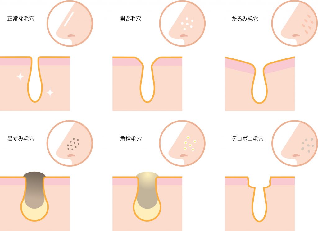 毛穴の開きの種類｜紀尾井町プラザクリニック