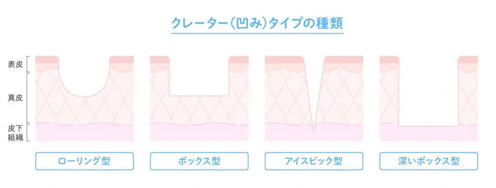 クレータータイプの種類｜紀尾井町プラザクリニック