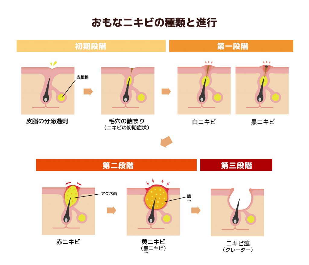 主なニキビの種類と進行｜紀尾井町プラザクリニック