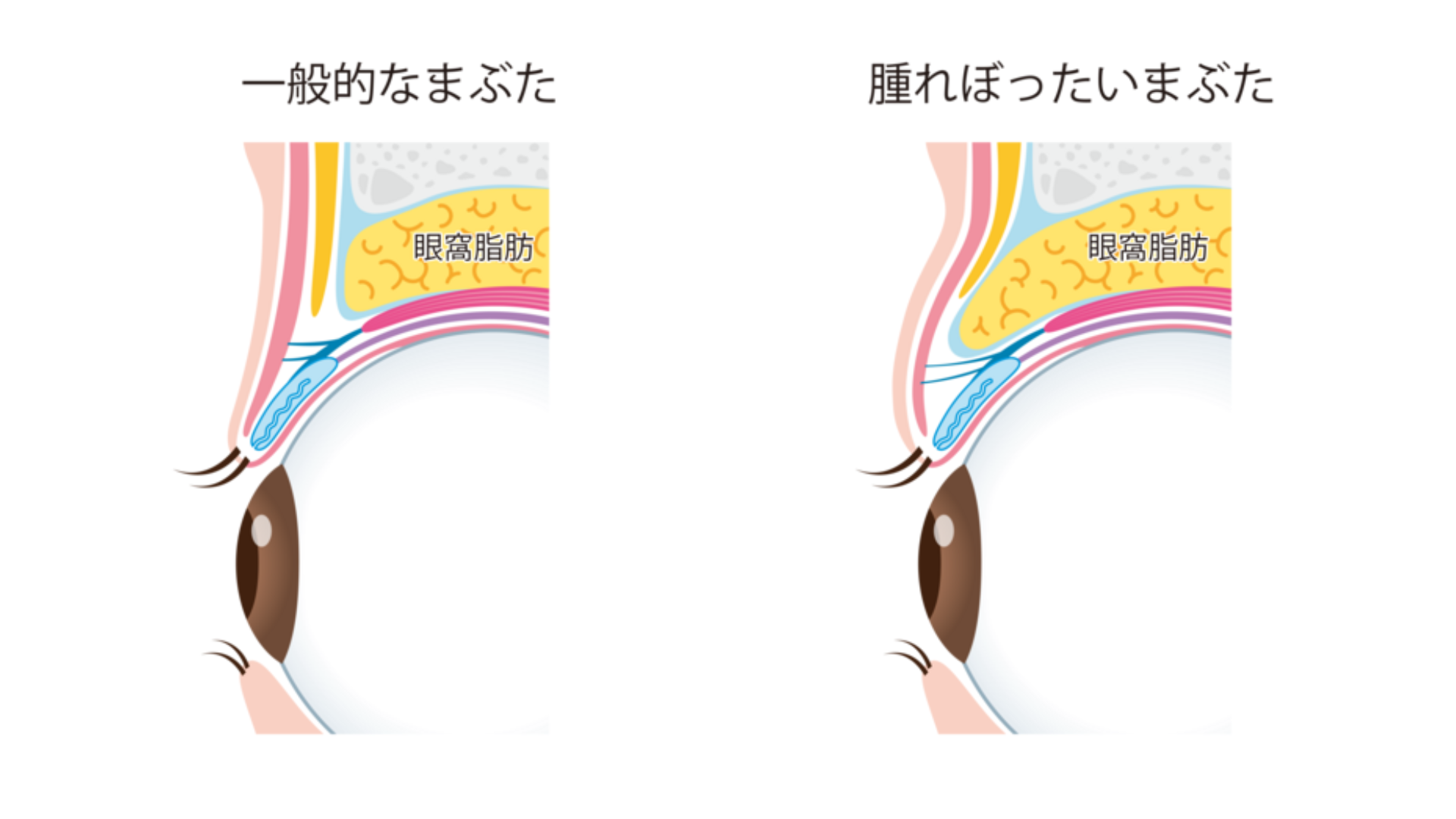 二重になりづらい人の特徴