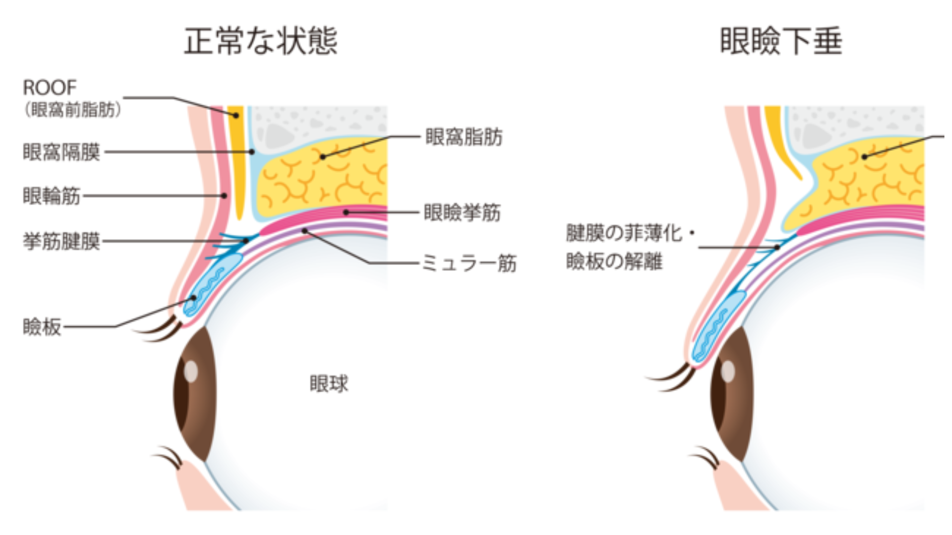 眼瞼下垂