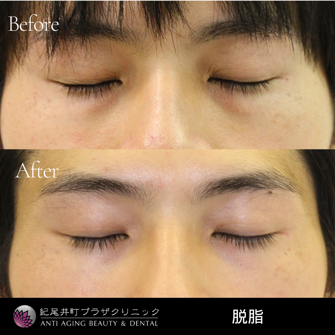 脱脂術の症例写真
