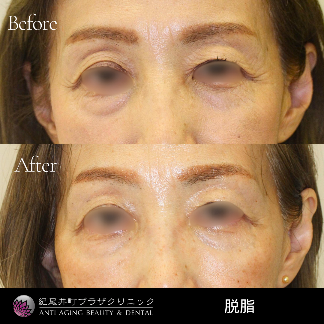 脱脂術の症例写真