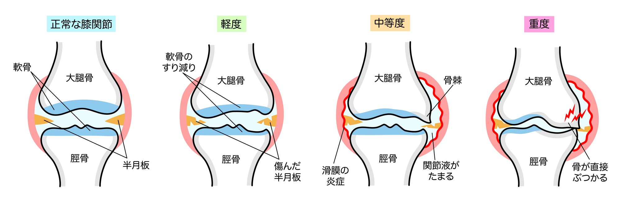 変形性膝関節症