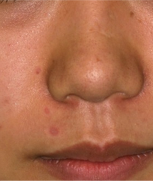 顔面に多発するほくろに対して炭酸ガスレーザー治療を施行した症例
